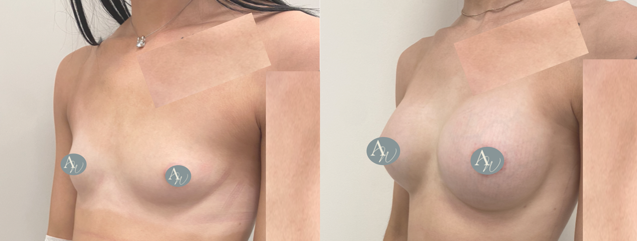 Avant/Après prothèses mammaires